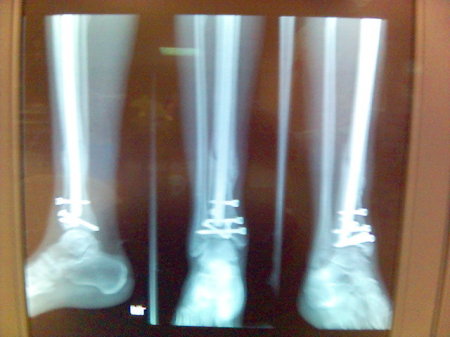 X-ray