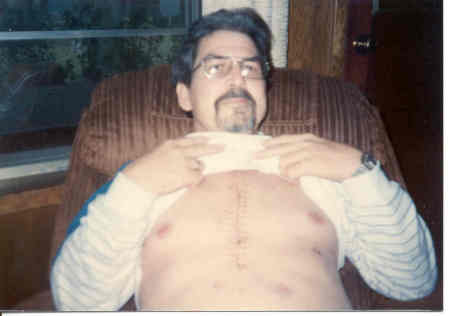 Wonderful lifesaving scar of HEART TRANSPLANT 1991