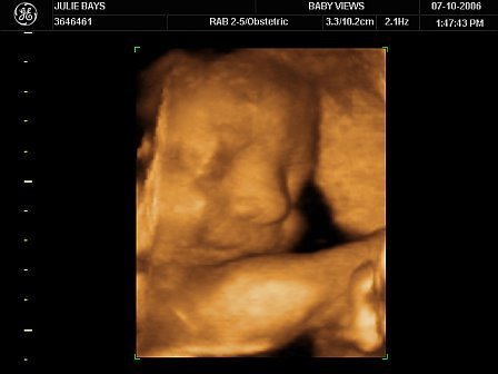 32 week ultrasound picture