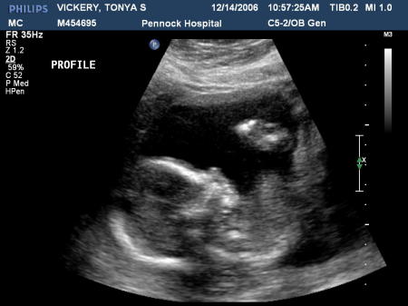 My 1st Baby's First Baby Photo (It's a Girl!)