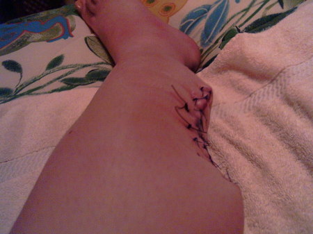 my leg after "shark Bite"