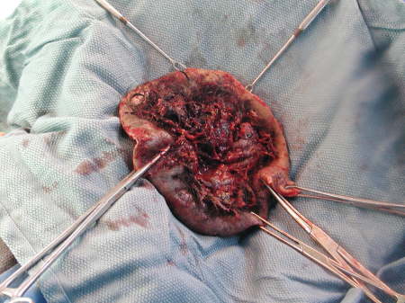 Portion of Scalp Removed