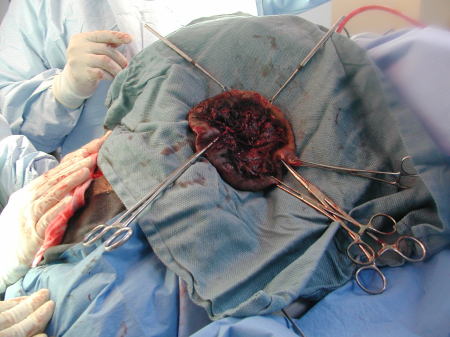 Portion of Scalp Removed
