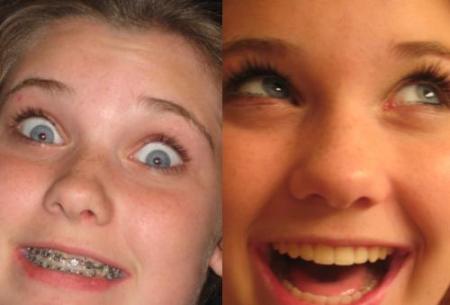 My Youngest daughter with/without braces