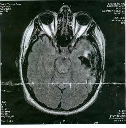 brain tumor