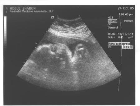 My son at 35 weeks!