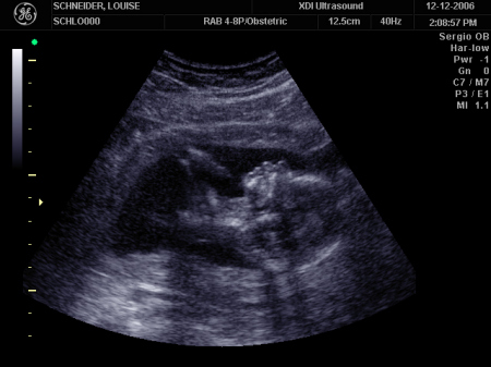 Sonogram - Our Son at 18 Weeks