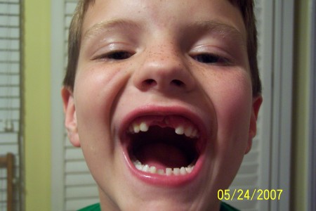 Cameron --Finally lost his tooth