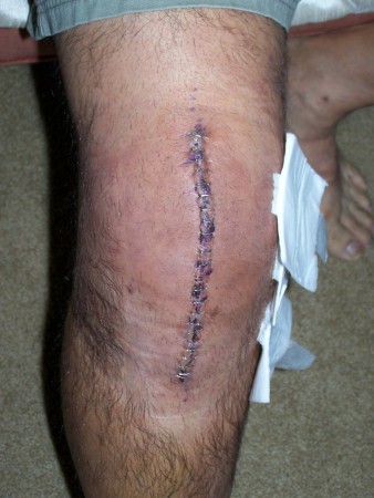 The new Knee