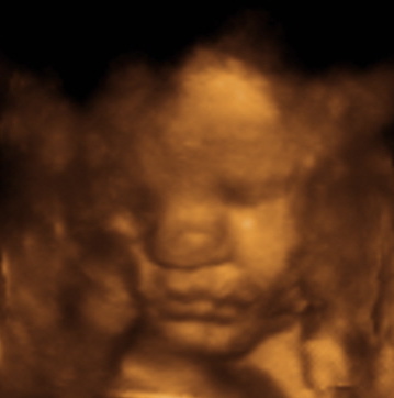 My son Parker at 32 weeks on 7/31/07