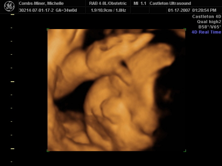 Eli, 34 weeks gestation