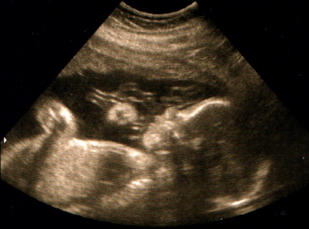 Parker at 24 weeks