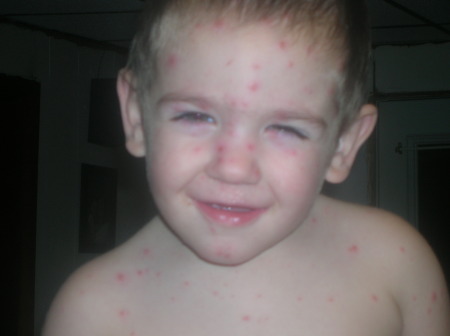 My little man with chicken pox