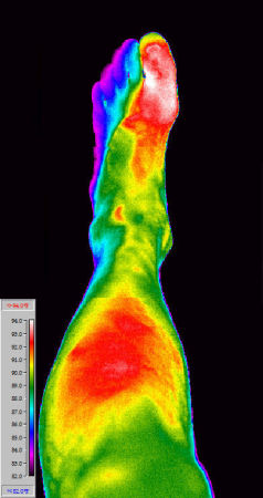 Infrared of Inframed Left Grand Toe