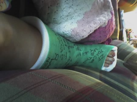 broken leg cast #1