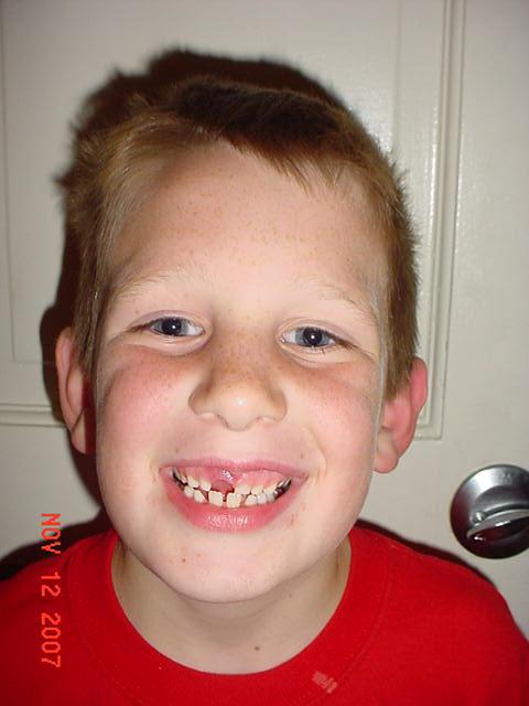 Missing his front tooth