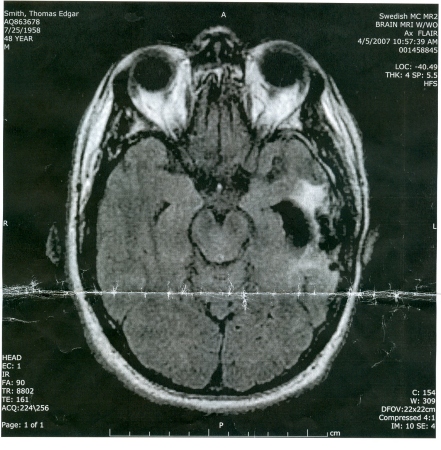 brain tumor