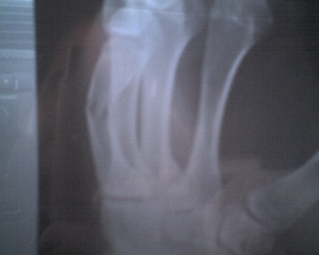 Cody boxers fracture
