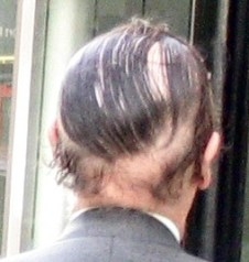 This is just a bad comb over.