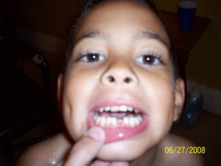 First Missing Tooth