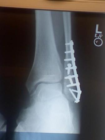 Picture of the Xray after surgery