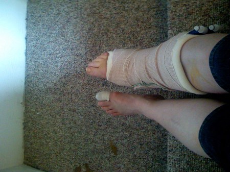 March 2008 Ankle Surgery