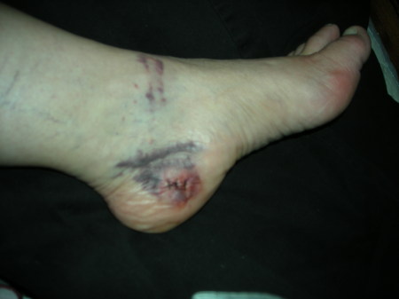 my foot after car wreck and  1st surgery