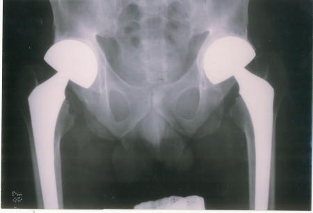 Titanium Hips