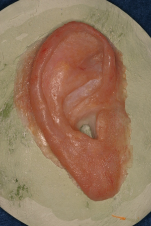 Auricular (ear) Prostheses