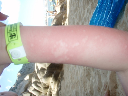 ouch attacked by jellyfish!