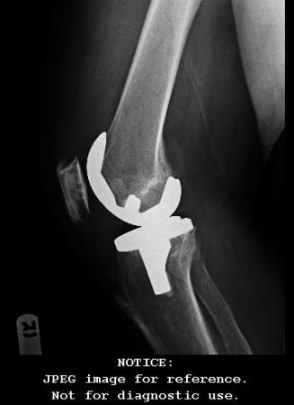 LATERAL POST OP XRAYS