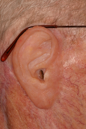 Auricular (ear) Prostheses