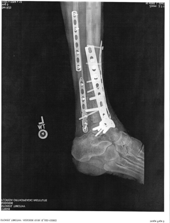 Left ankle, 14 plates-23 screws