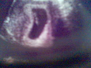 My First UltraSound Pic