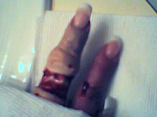 Degloved finger