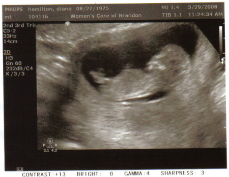 Ultrasound 12 weeks