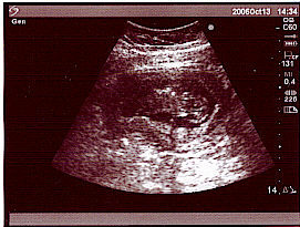 1st Baby Picture