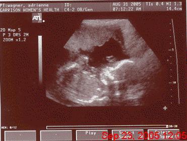 My Son Victor James-20 week ultrasound