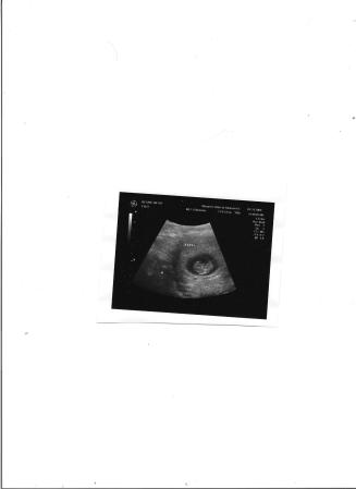 10 week ultrasound