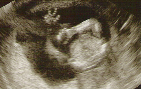 Kaylee's ultrasound