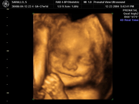 Ashley's 3D ultrasound photo