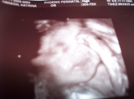 3D Ultrasound Pic 1