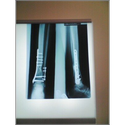 My "new" Leg