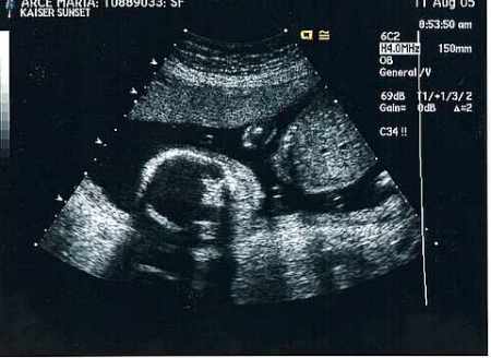 Baby Andrew's Picture in his Mommy's womb
