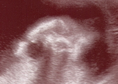 Crumb's 21 Week Ultrasound