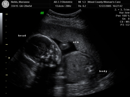 5 month ultrasound photo