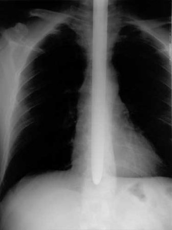 Xray of Sword Swallower Dan Meyer