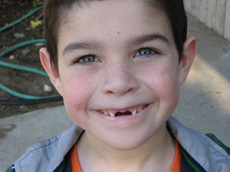 My Youngest (Matthew) Just turned 6 and lost his two front teeth