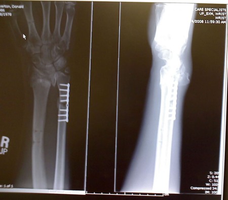 xray of my right wrist