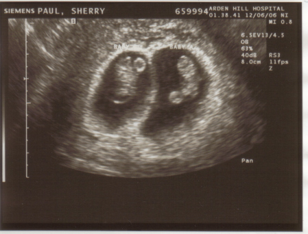 TWINS!  Due June 2007